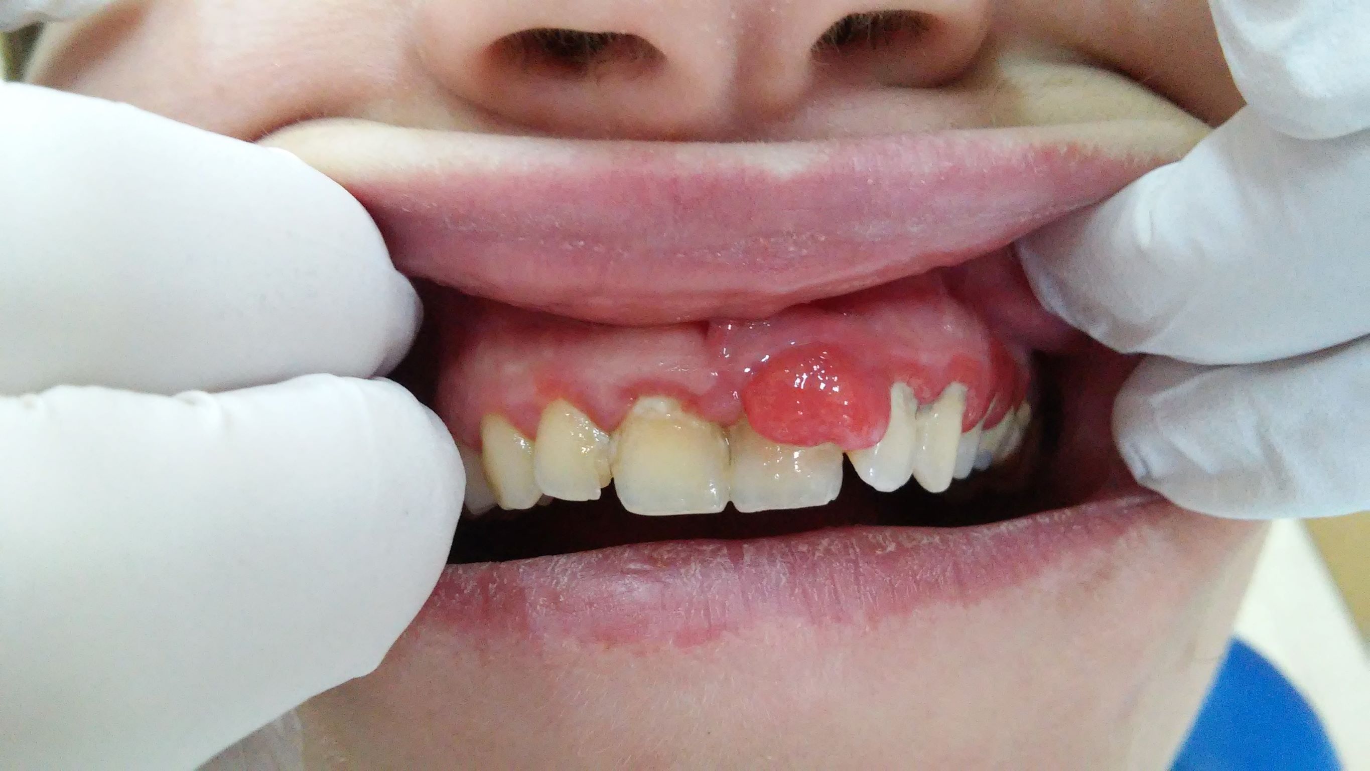 Zmiany błon śluzowych w jamie ustnej? Pomoże periodontolog!