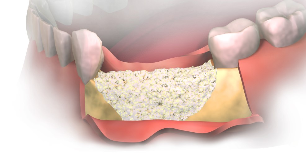 Augmentacja kości przed wszczepieniem implantu zębowego – na czym polega zabieg i kiedy jest potrzebny?