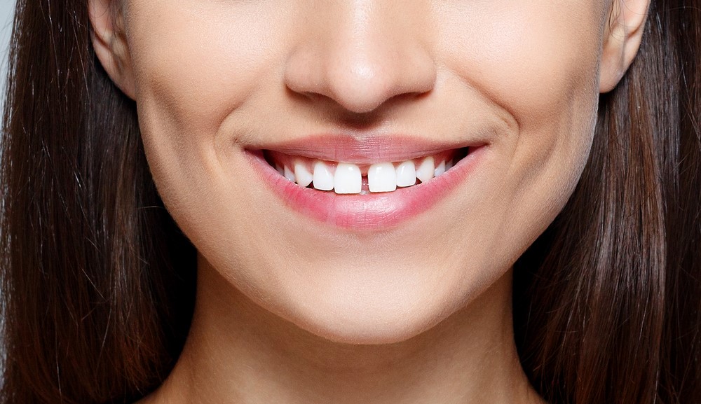 Co to jest diastema i jak ją zlikwidować?
