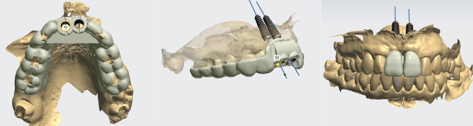 Implantacja nawigowana i szablony chirurgiczne