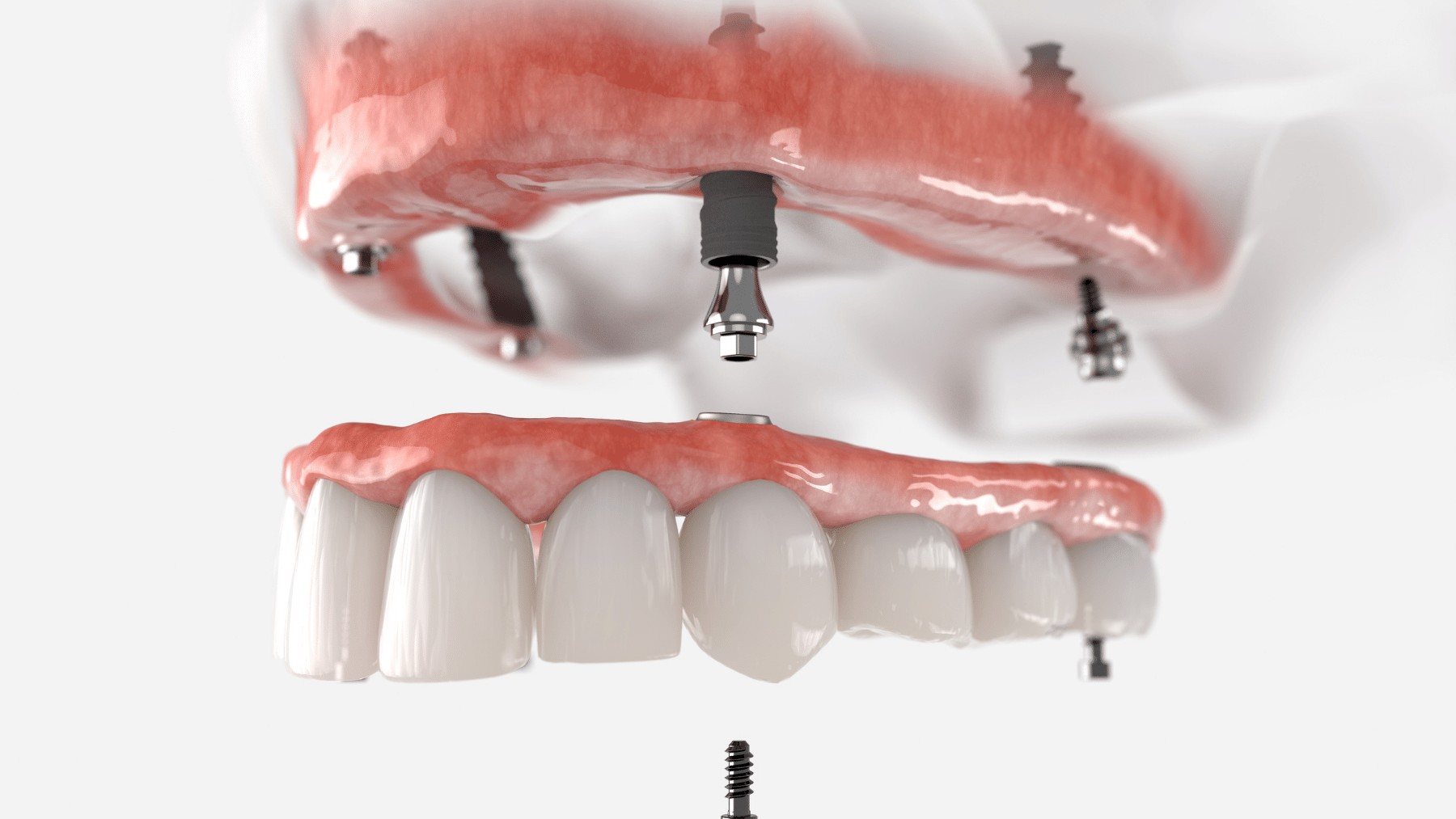 Najdoskonalsze protezy zębowe: mosty na implantach