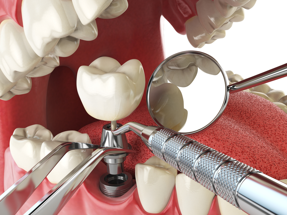 Implanty – na co zwrócić uwagę wybierając klinikę i dentystę?